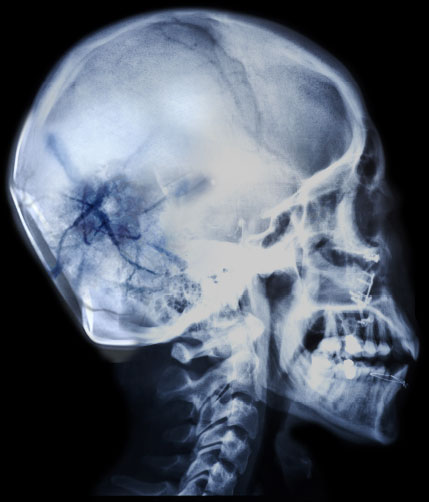 510-SKULL-CRACK-RIGHT